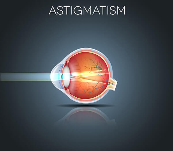 Astigmatism diagram