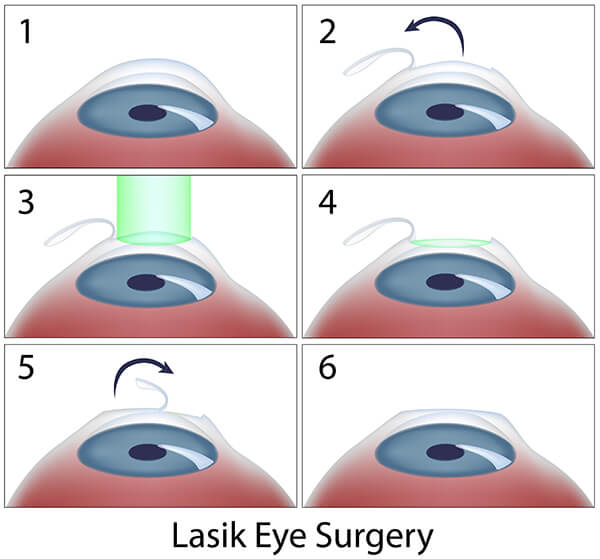 LASIK Steps Diagram